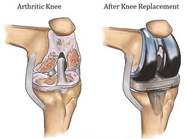 Knee Replacement Surgery